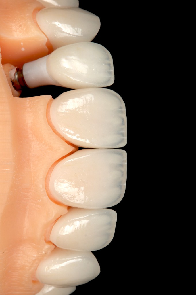 Charecterized ceramic restorations with implant abutment