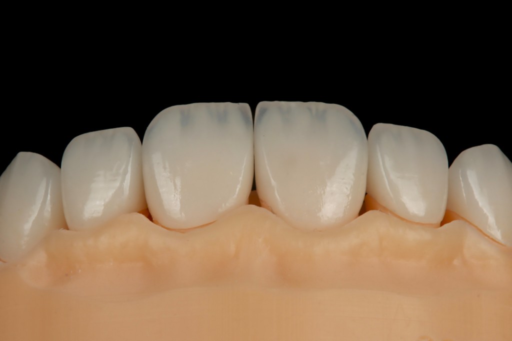 Charecterized anterior veneers on dental model