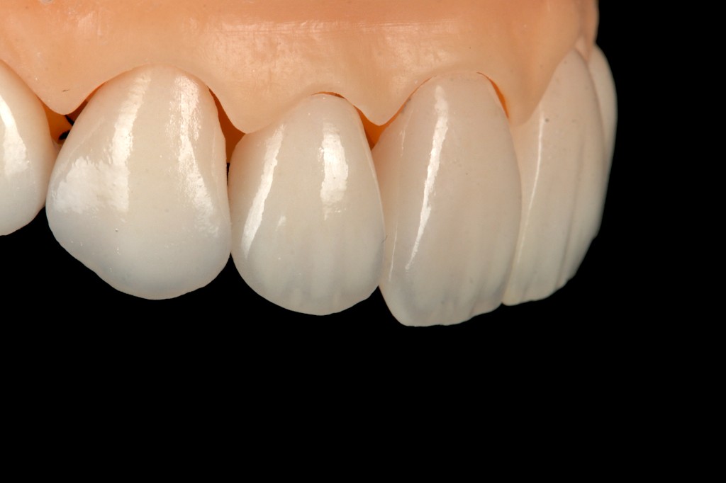 Charecterized porcelain units with gingival contour