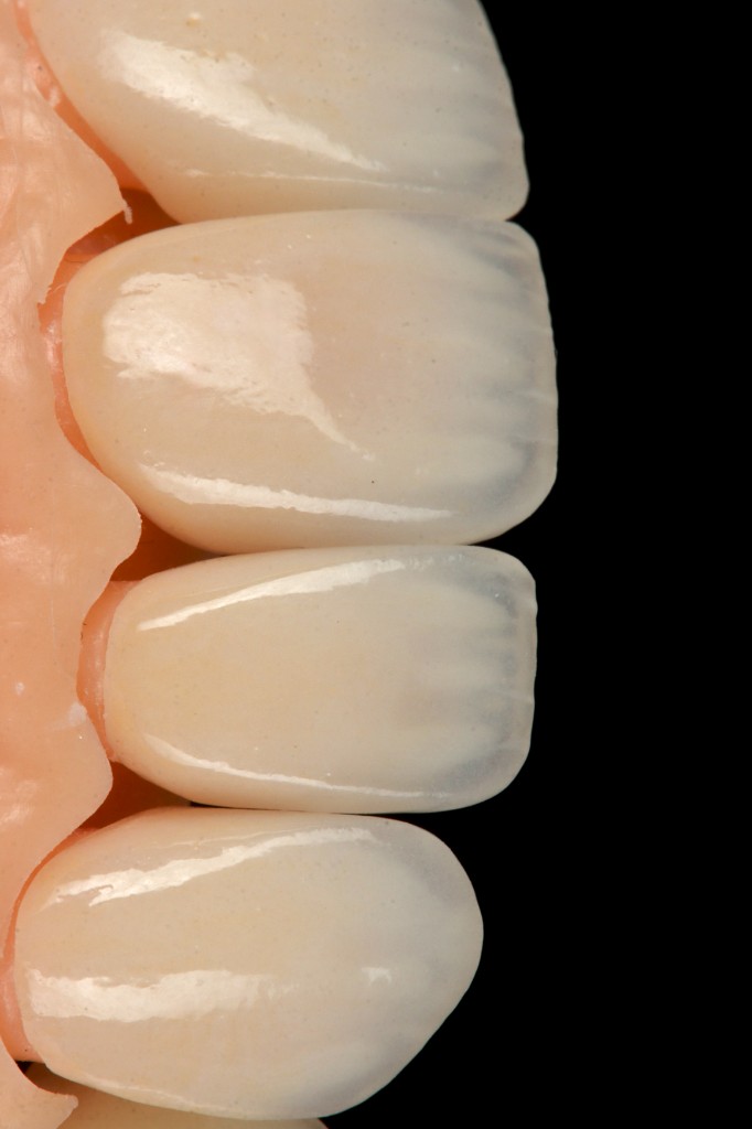Charecterized translucent veneer detail
