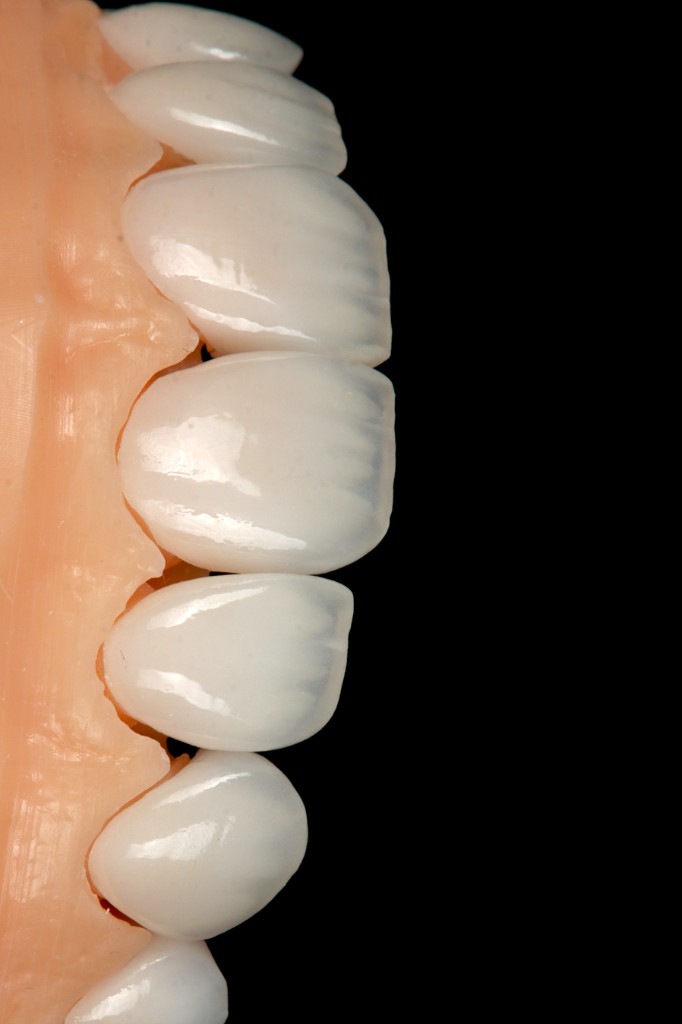 Charecterized profile view of ceramic restorations