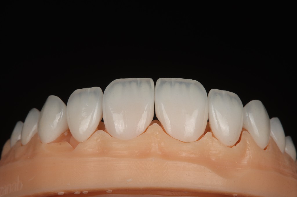 Charecterized full anterior arch on model