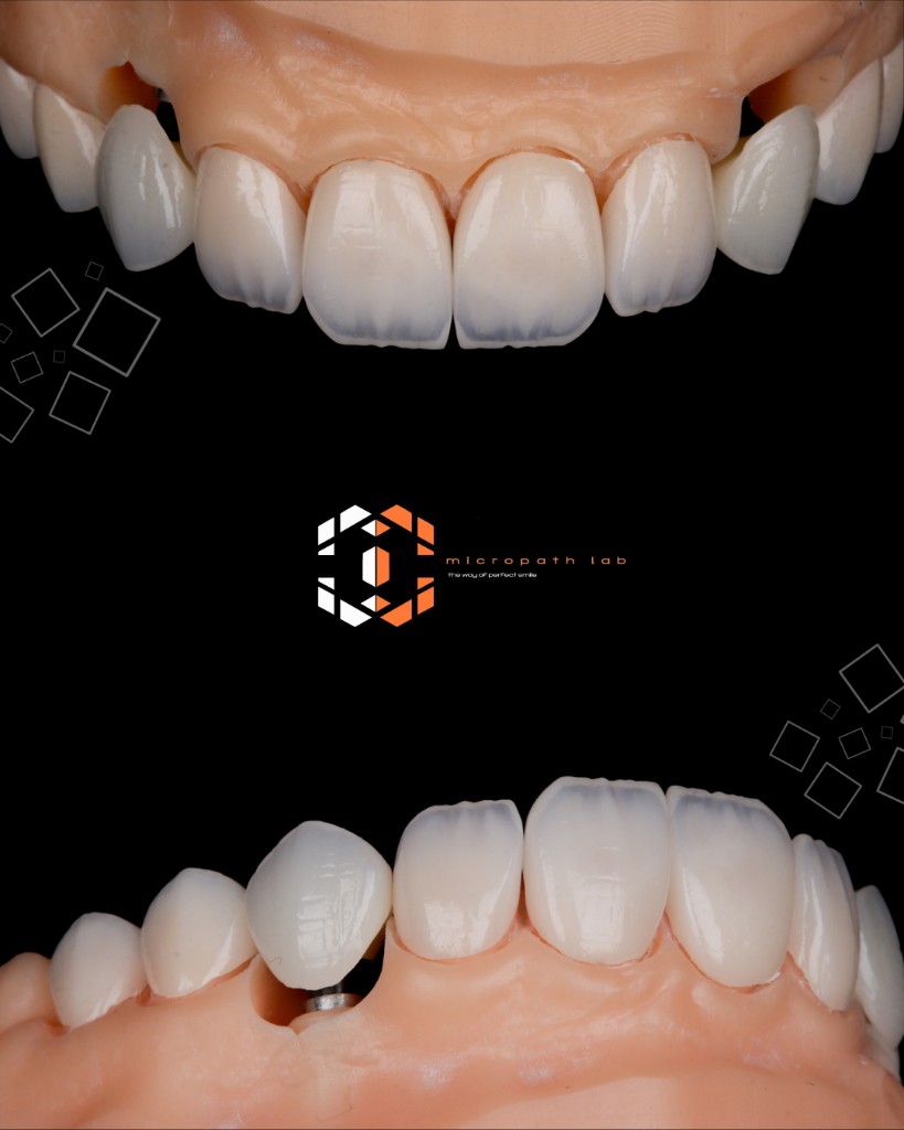 Charecterized implant restoration presentation