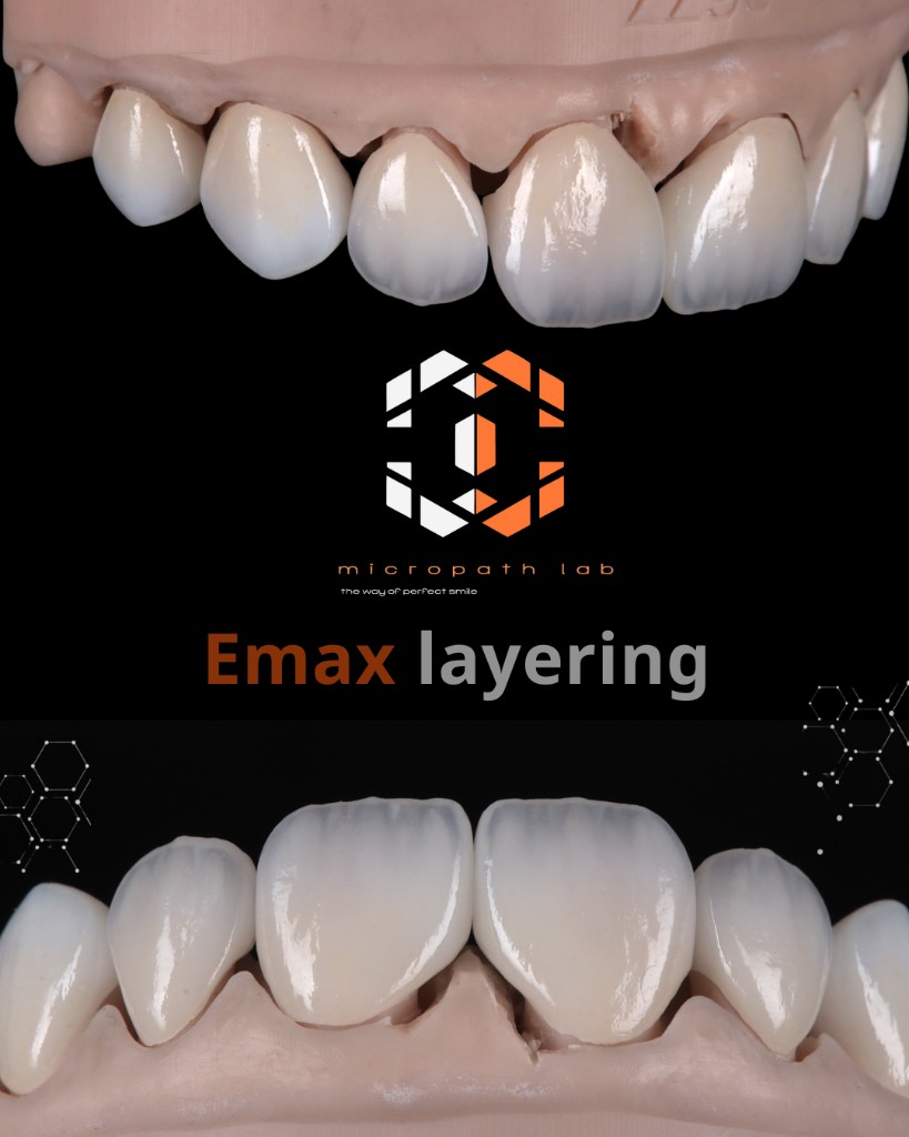 Charecterized Emax layering case board