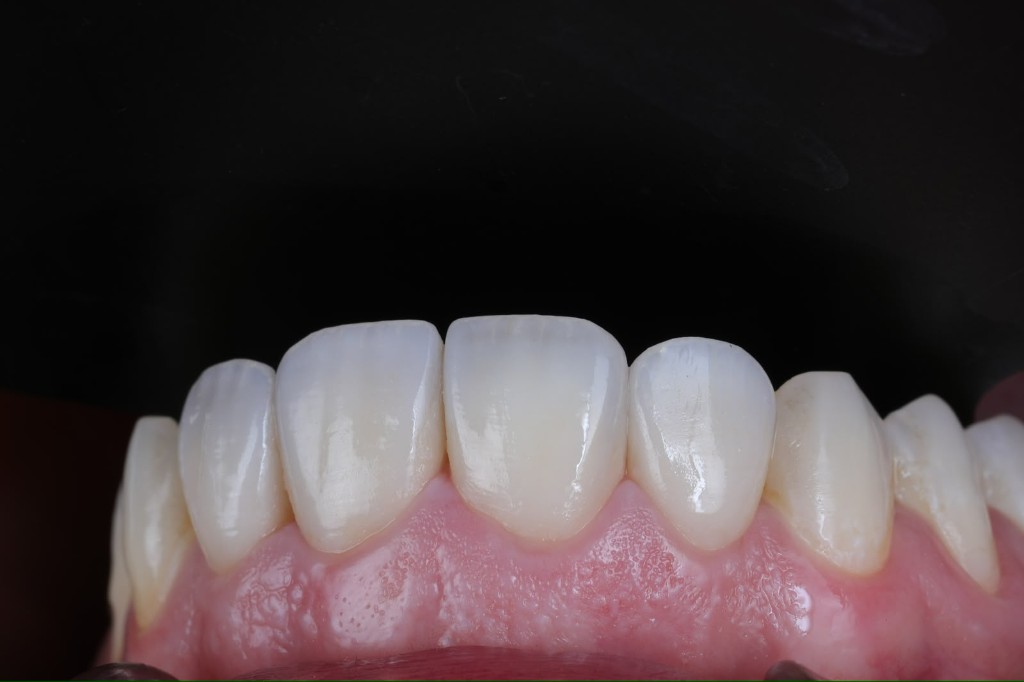 Classically veneer case — clinical smile detail
