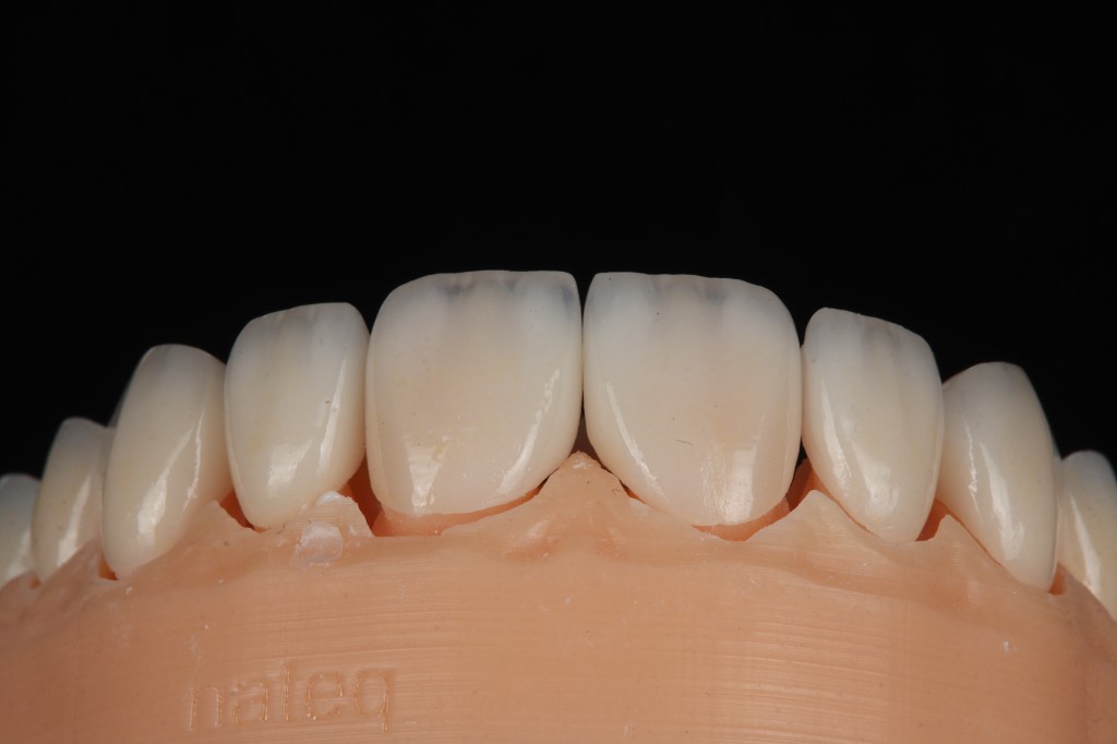 Classically ceramic restorations on dental model