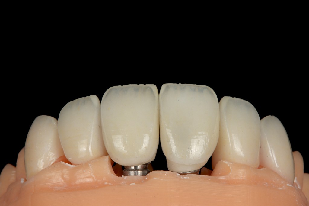 Classically anterior restorations with implant abutment