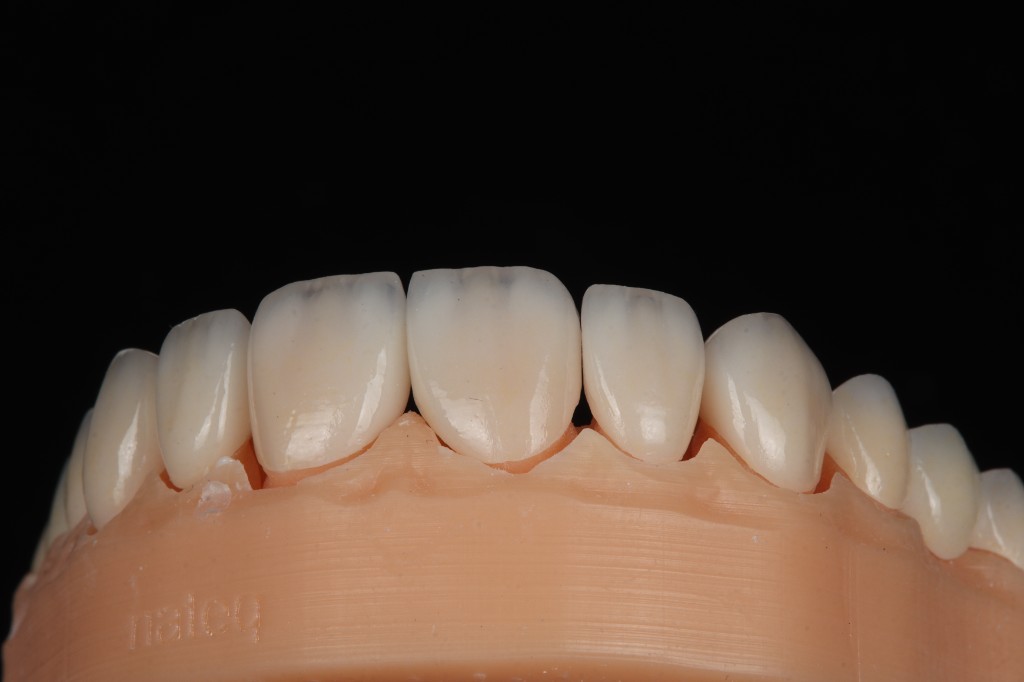 Classically porcelain veneer set on model