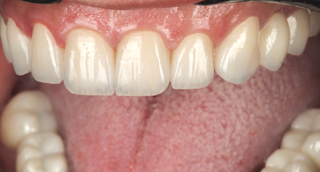 Classically finished smile in mouth