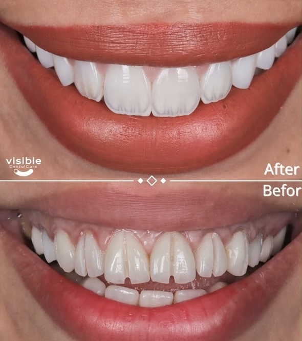 Visible Clinic before and after smile transformation