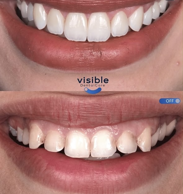 Visible Clinic before and after veneer case