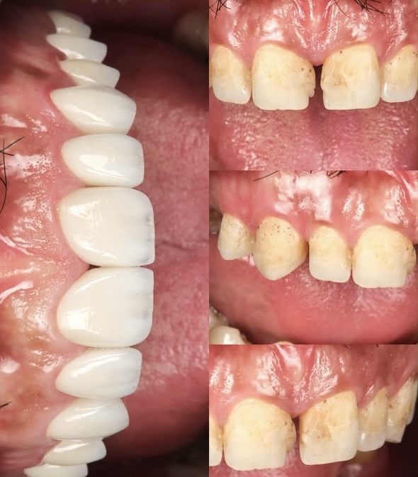 Visible Clinic smile makeover before and after
